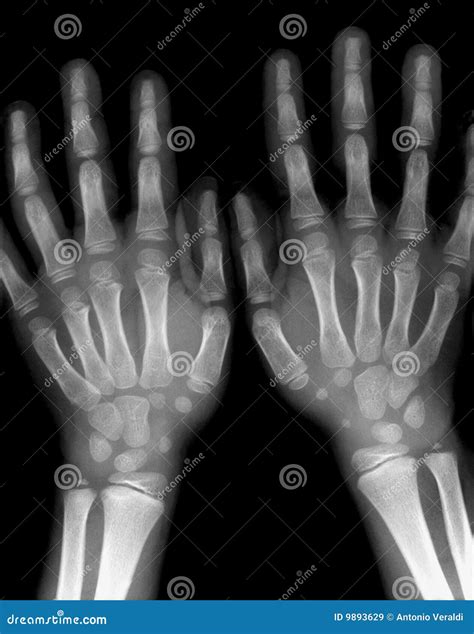 X Ray Hands Royalty Free Stock Images Image 9893629