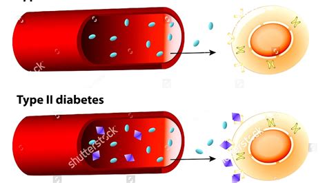 Diabetes Mellitus Type 1 Insulin Insulin Choices