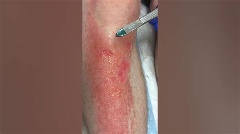 Capillary Return In Minor Superficial Burns Youtube