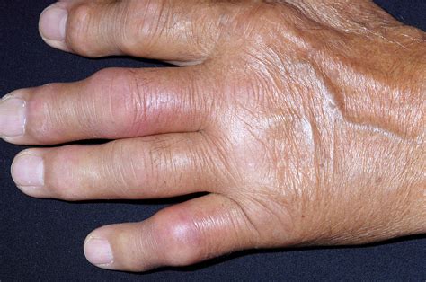 Gout Photograph By Dr P Marazziscience Photo Library