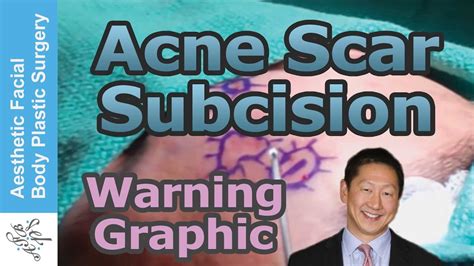 Live Surgery Acne Scar Revision Subcision Treatment For Depressed
