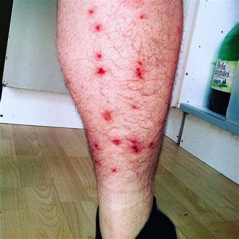 Bed Bug Bite On Leg