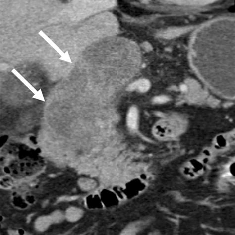 False Negative Case Of Pancreatic Ductal Adenocarcinoma That Is