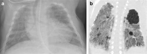 Lung Findings Of Bronchopulmonary Dysplasia On Radiography And Ct A