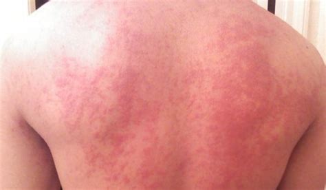 3 Hives Symptoms And How To Treat Them Vujevich Dermatology