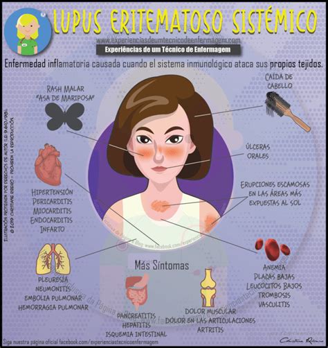 Lupus Eritematoso Sistémico Enfermagem Ilustrada