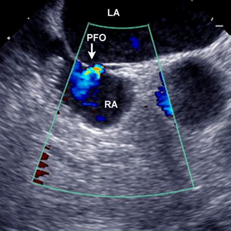 Transesophageal Echocardiography A Patent Foramen Ovale Pfo With A
