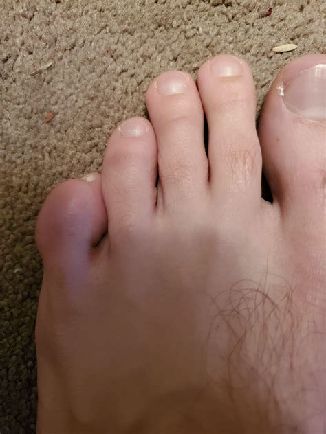Can Anyone Tell Me Whats Wrong With My Pinky Toe Rpodiatry
