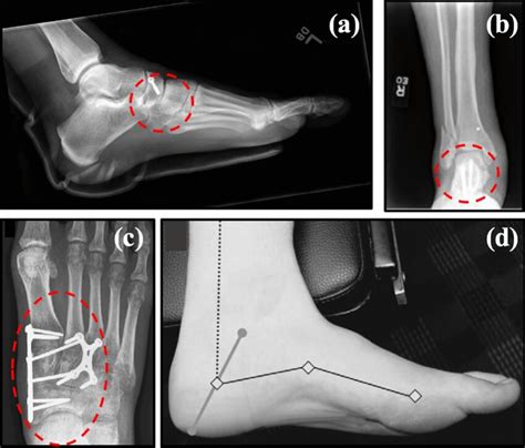 A Navicular Stress Fracture Reprinted With Permission From Elsevier