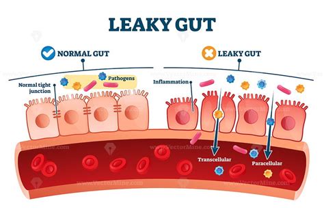 leaky gut syndrome as medical chronic inflammation condition explanation vectormine