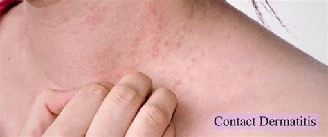 Skin Allergy Reason And Treatment