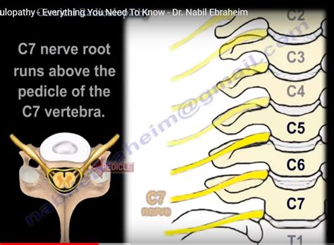 Cervical Disc Herniation And Radiculopathy —