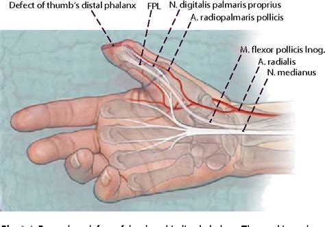 Reconstruction Of The Thumb Tip Using Palmar Neurovascular Flaps