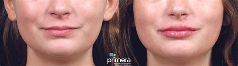 JUVÉDERM Before and After Pictures Case 818 Orlando Florida