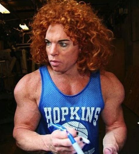 Bicep Implants Really Carrot Top Plastic Surgery Horrorshow