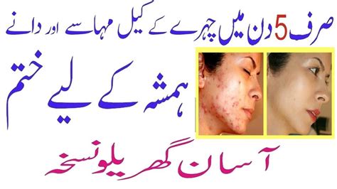 We did not find results for: acne treatment | acne treatment at home | dano ka ilaj ...