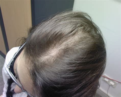 Women and men experience hair loss for a variety of reasons as they age, such as hereditary traits, endocrine disorders, thyroid disorders, reduced hormonal support, and nutritional deficiencies. The Hair Centre | FEMALE HAIR LOSS: RESULTS