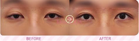 why korean ptosis correction eyelid surgery is different guide reviews promotions misooda