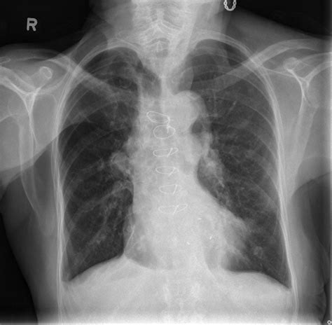 Lateral Chest X Ray Digital Double Dipping WikiRadiography Hot Sex Picture