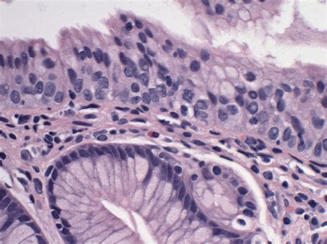 Focus Of Well Developed Multilayered Epithelium Showing Basal Cells