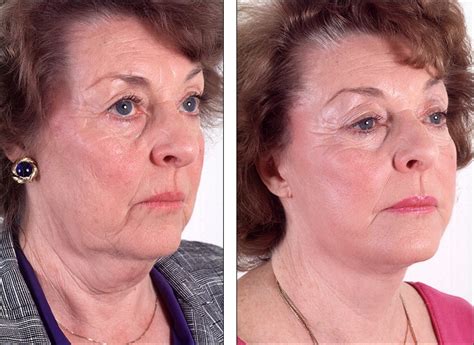 Dr Steven Denenbergs Facial Plastic Surgery Before And Afters Face