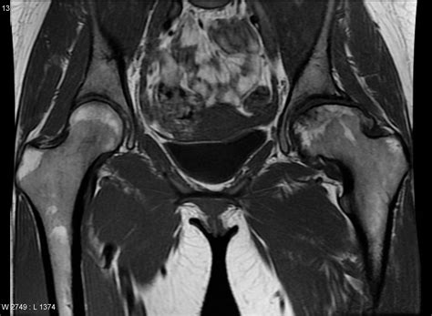 Previous Avascular Necrosis Of The Left Hip Image