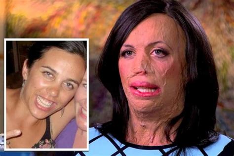 What Exactly Happened To Turia Pitt Her Accident Details Before And After Burns Photos Celeb