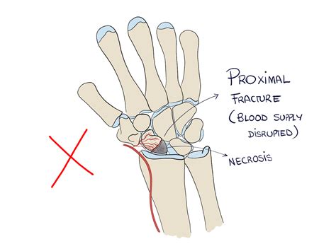Proximal Pole Scaphoid Fracture