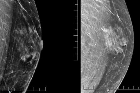 If you want to do everything you can to lower your breast cancer risk, limiting how much alcohol you drink makes sense. Things Men Should Know About Their Risk for Breast Cancer