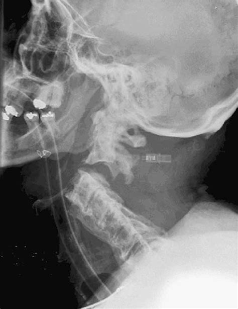 Dislocated Neck X Ray