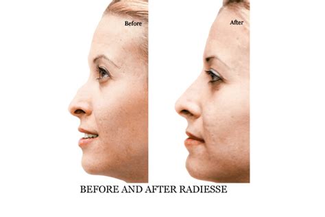 Check the ranking of 20 plastic surgery republic of korea clinics based on she accompanied me throughout the appointment and translated when necessary. Non Surgical Nose Job / Rhinoplasty in London - 111 Harley St.