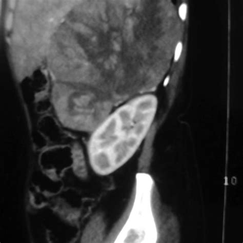 Contrast Enhanced Ct Scan Showing Well Defined Heterogeneously