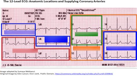 The Lead Ecg Anatomic Locations And Supplying Coronary Arteries
