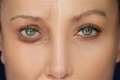 Frownies Before And After A Safe Way To Erase Wrinkles And Fine Lines