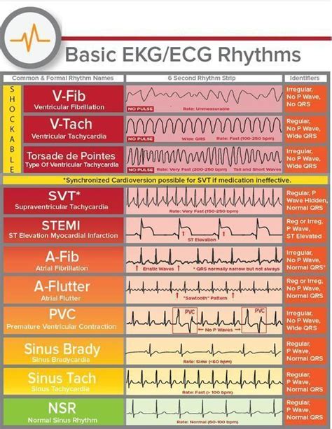 Basic Ekgecg Rhythms Medschool Doctor Medicalstudent Image