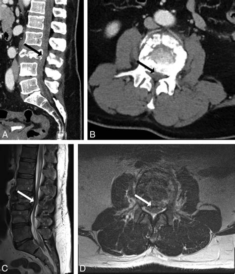 Cauda Equina Syndrome Mri Protocol Captions Trendy