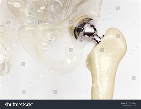 Artificial Hip Joint After Severe Osteoarthritis Stock Illustration