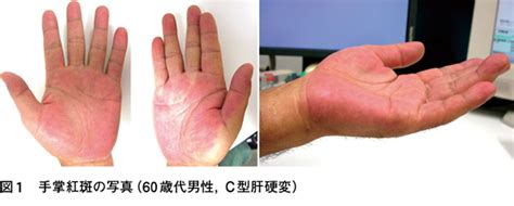 肝臓の手（手掌紅斑）｜web医事新報日本医事新報社