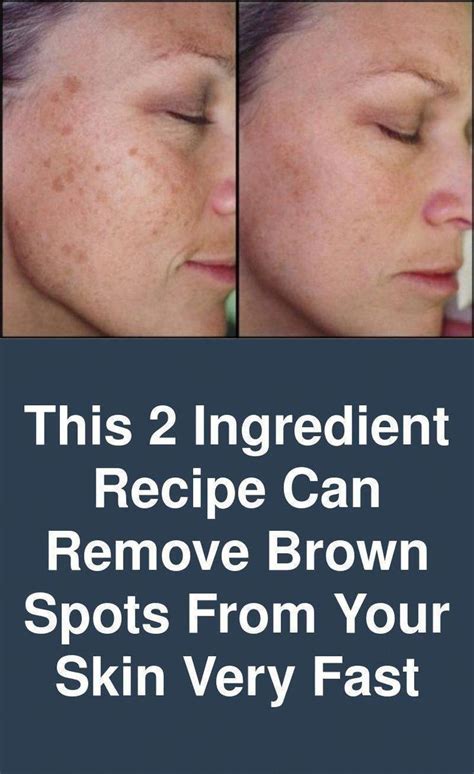 tips on how to eliminate black spots on confront in a single day brownspotsonface in 2020