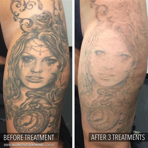 Update More Than 72 Tattoo Removal Before After Pictures Best