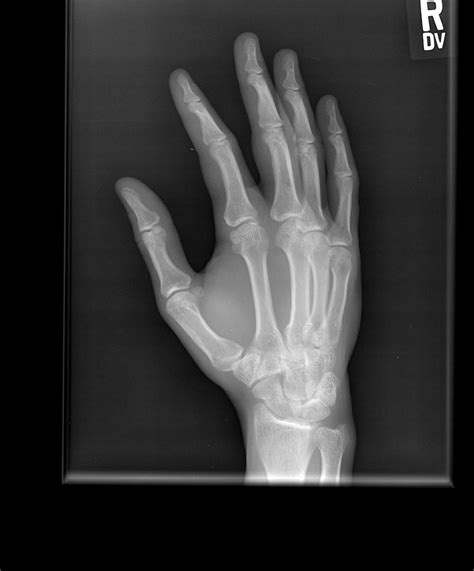 Top 93 Pictures Normal X Ray Of Hand And Wrist Sharp