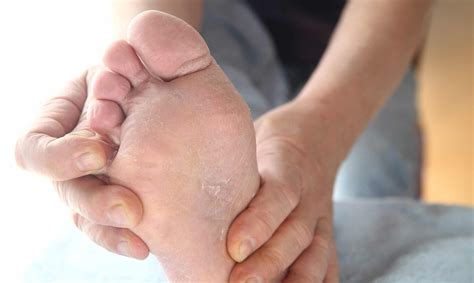 Peeling Feet Causes And Treatments According To Experts Ph
