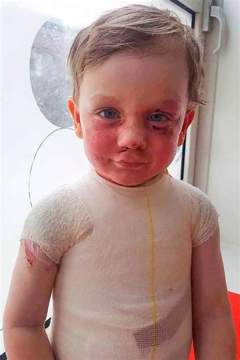 Mum Shares Shocking Pictures Of Toddlers Burns After Jug Of Boiling