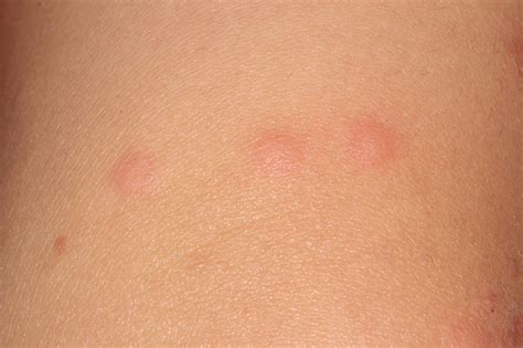 Bedbugs Arthropod Reaction Dermatology Advisor