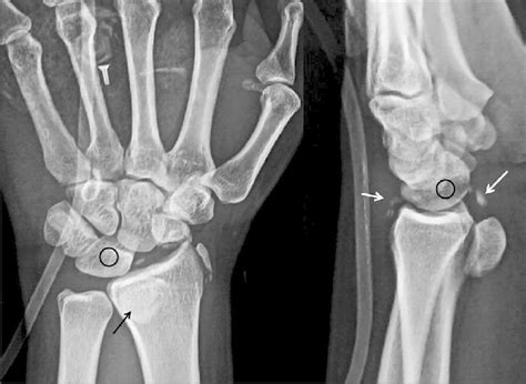 Frontal And Lateral Wrist Radiograph Showing Evidence Of Fracture Of Download Scientific
