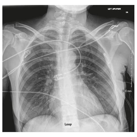 Needle Insertion Into The Lesion Close To Hila No Pneumothorax