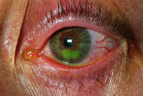 Corneal Abrasion With Staining Photograph By Dr P Marazzi Science My Xxx Hot Girl