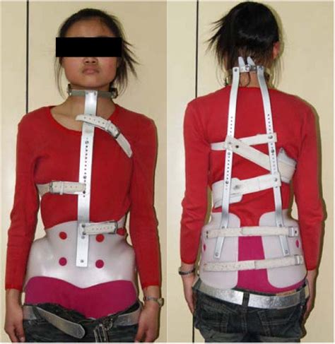 The Influence Of Elastic Orthotic Belt On Sagittal Profile In Adolescent Idiopathic Thoracic