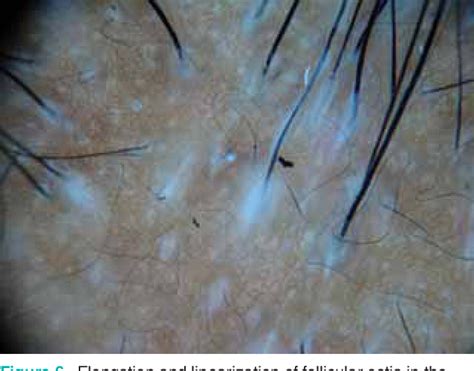 Trichotillomania Hair Follicle Parasite
