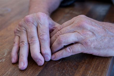 Psoriatic Arthritis Types Symptoms Causes And Treatments